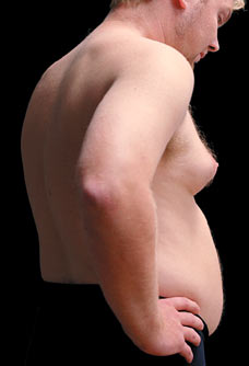 Gynecomastia
